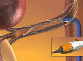 Resultados a 12 meses de la denervación de las arterias renales en hipertensión resistente