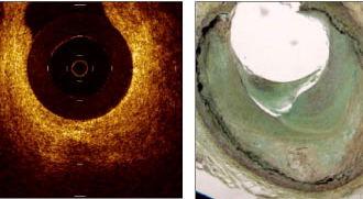 Efecto de la terapia con Atorvastatina sobre el espesor de la capa Fibrosa de la placa ateromatosa coronaria