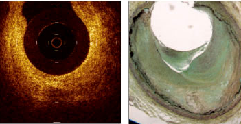 Efecto de la terapia con Atorvastatina sobre el espesor de la capa Fibrosa de la placa ateromatosa coronaria