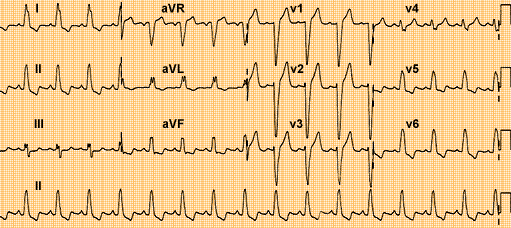 Resolución de miocardiopatía inducida por bloqueo de rama izquierda a través terapia de resincronización cardiaca – SIAC