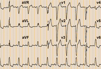 Resolución de miocardiopatía inducida por bloqueo completo de rama izquierda a través terapia de resincronización cardiaca