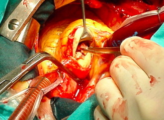 Sangrado asociado a Cirugía de revascularización miocárdica en pacientes tratados con Ticagrelor o Clopidogrel