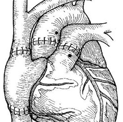 La enfermedad cardíaca congénita del adulto