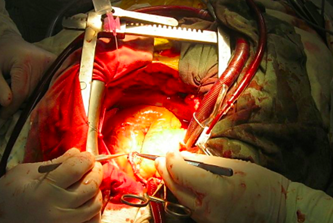 STICHES: Cirugía de revascularización coronaria en pacientes con disfunción ventricular izquierda