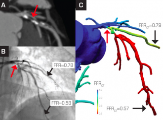 Cuantificación de placa coronaria y reserva fraccional de flujo por tomografía computada coronaria indentifica lesiones causantes de isquemia