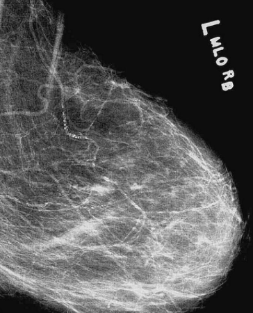 La presencia de calcificación de las arterias mamarias en la mamografía