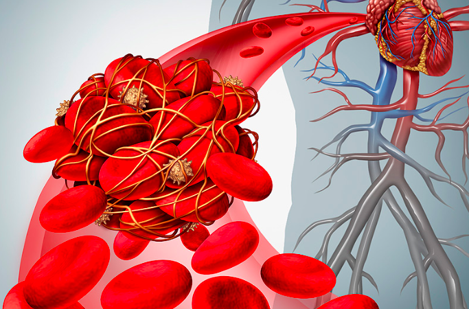 Prevención de sangrado en pacientes con FA sometidos a angioplastia coronaria
