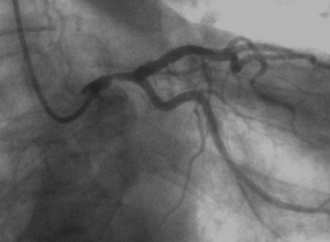 Stents liberadores de everolimus o cirugía de revascularización miocárdica en enfermedad de tronco de coronaria izquierda
