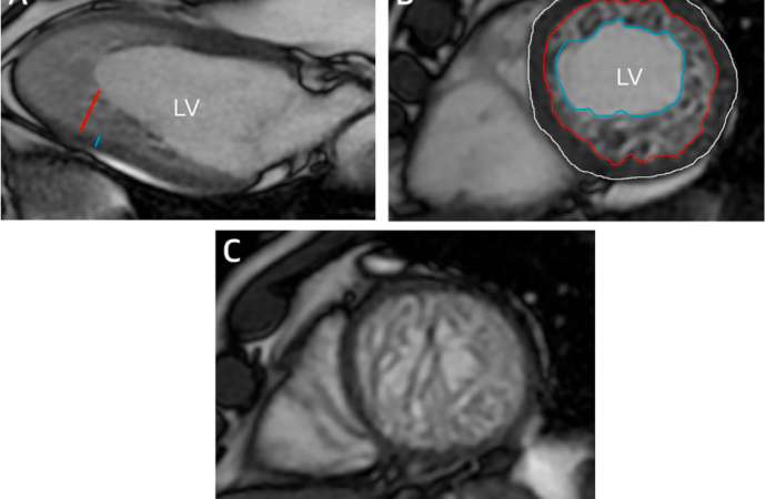 Pronóstico a largo plazo de la Resonancia Magnética en Miocardio no Compacto
