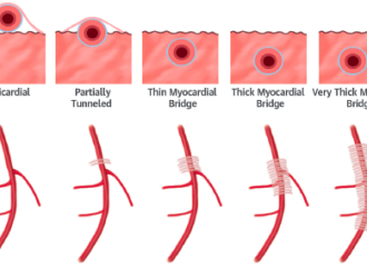 Puente muscular de la Arteria Descendente Anterior