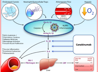 Terapia antiinflamatoria en Aterosclerosis Coronaria con Canakinumab