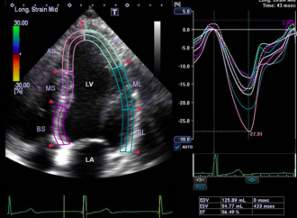 Cambios agudos de la funcion ventricular izquierda detectados con el estudio de la deformacion miocardica, luego del consumo excesivo de alcohol
