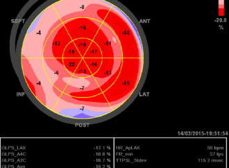 Diferentes Patrones del «Bull´s Eye» en Strain longitudinal de pacientes con miocardiopatía e hipertrofia ventricular izquierda concéntrica