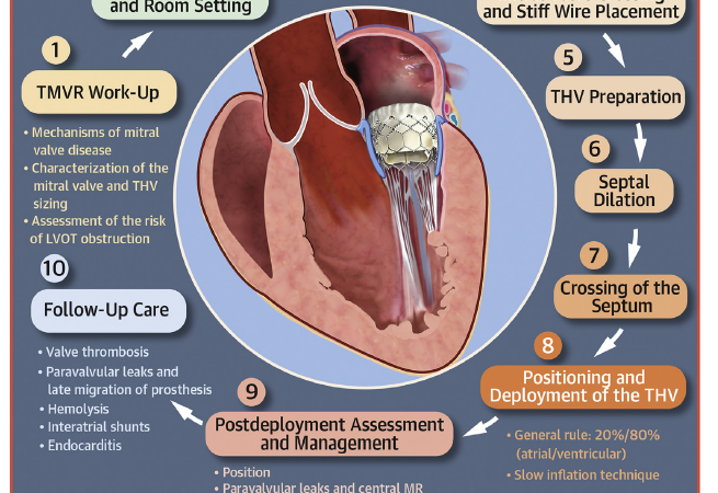 Reemplazo Valvular mitral transeptal transcatéter usando Válvulas cardíacas expandibles con balón