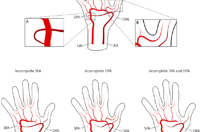Análisis anatómico y funcional de la vasculatura palmar y su relación con eventos post cateterismo transradial
