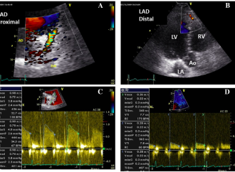 Es posible detectar enfermedad coronaria significativa en forma no invasiva con ecocardiografía doppler?