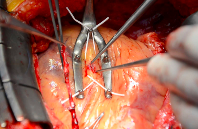 Cirugía Revascularización Con vs Sin Bomba de circulación extracorpórea