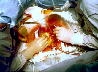 Arteria Radial vs Vena Safena en Cirugía Revascularización Miocárdica