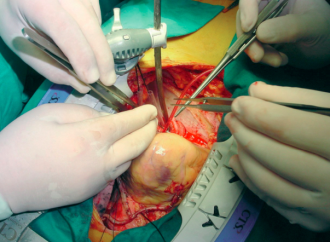 ¿Cuánta evidencia científica necesitamos para extender la revascularización arterial en la cirugía coronaria?