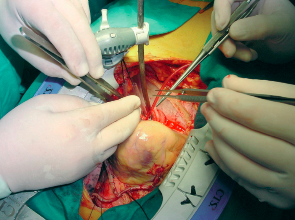 ¿Cuánta evidencia científica necesitamos para extender la revascularización arterial en la cirugía coronaria?