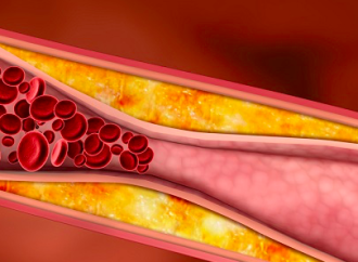 Interjuego entre Hipercolesterolemia e Inflamación en aterosclerosis