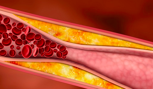 Interjuego entre Hipercolesterolemia e Inflamación en aterosclerosis