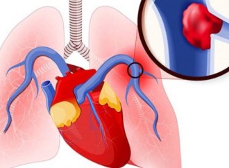 Rol del ecocardiograma en el manejo del tromboembolismo pulmonar agudo