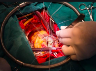 Resultados después de cirugía de la válvula mitral por enfermedad cardiaca reumática