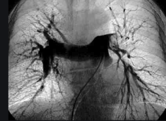 Tratamiento intervencionista en el tromboembolismo de pulmón agudo