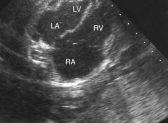 Dilatación de las cámaras cardiacas derechas en el feto: posibilidades diagnósticas