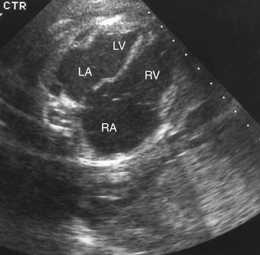 Dilatación de las cámaras cardiacas derechas en el feto: posibilidades diagnósticas
