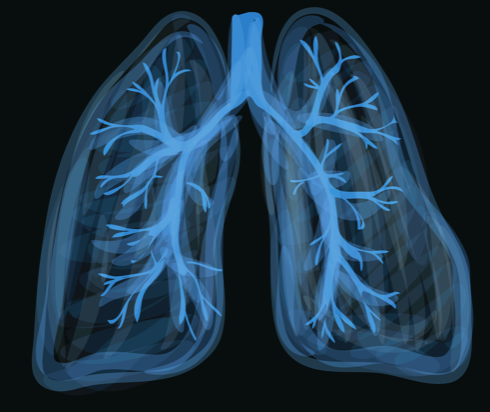 Presentación clínica, tratamiento y resultados a corto plazo de la lesión pulmonar asociada con cigarrillos electrónicos o vapeo