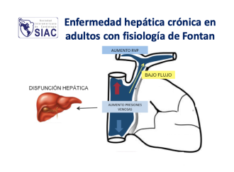 Enfermedad hepática crónica en adultos con fisiología de Fontan