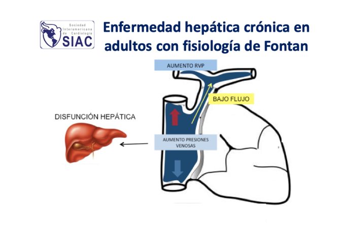 Enfermedad hepática crónica en adultos con fisiología de Fontan