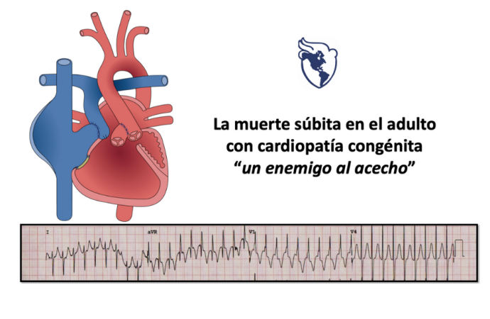 Predicción de muerte súbita de origen cardíaco en adultos con cardiopatía congénita