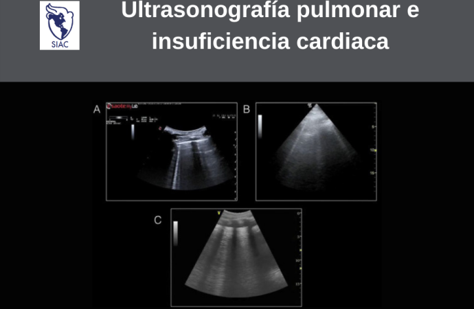 Ultrasonografía pulmonar e insuficiencia cardiaca: una revisión práctica