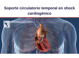 Soporte circulatorio temporal para el shock cardiogénico