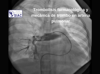 Trombolisis farmacológica y mecánica de trombo en arteria pulmonar