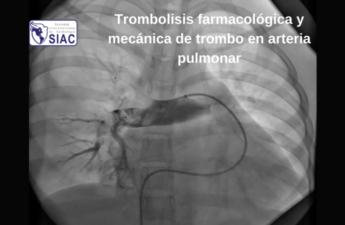 Trombolisis farmacológica y mecánica de trombo en arteria pulmonar