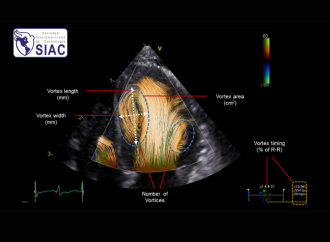 “Blood Speckle Imaging”: una nueva herramienta para el estudio de la dinámica de los flujos en Cardiopatías Congénitas