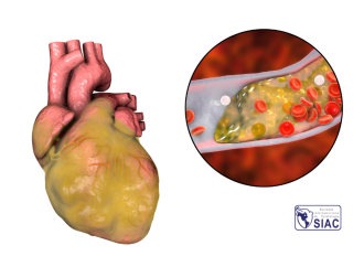 Reperfusión espontánea en pacientes con infarto agudo de miocardio y elevación transitoria del segmento ST – Prevalencia, importancia y terapéutica