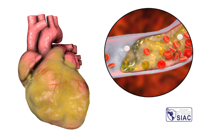 Reperfusión espontánea en pacientes con infarto agudo de miocardio y elevación transitoria del segmento ST – Prevalencia, importancia y terapéutica