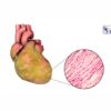 Diagnóstico y evaluación de la Miocardiopatía Hipertrófica