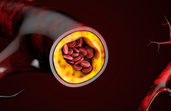 Remanentes de colesterol elevados son factor de riesgo para infarto de miocardio y cardiopatía isquémica