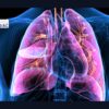 Impacto de la reperfusión pulmonar en pacientes con embolia pulmonar de riesgo intermedio-alto