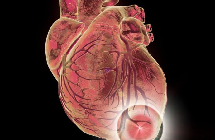 Remodelación del Ventrículo Izquierdo post-Infarto del Miocardio: fisiopatología, imagenología, y nuevas terapias